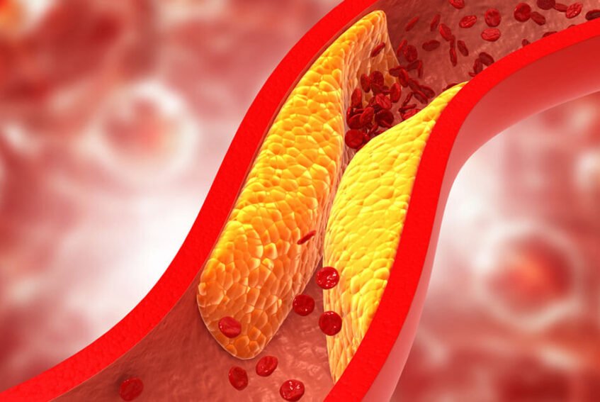 Lipid-Lowering Agent